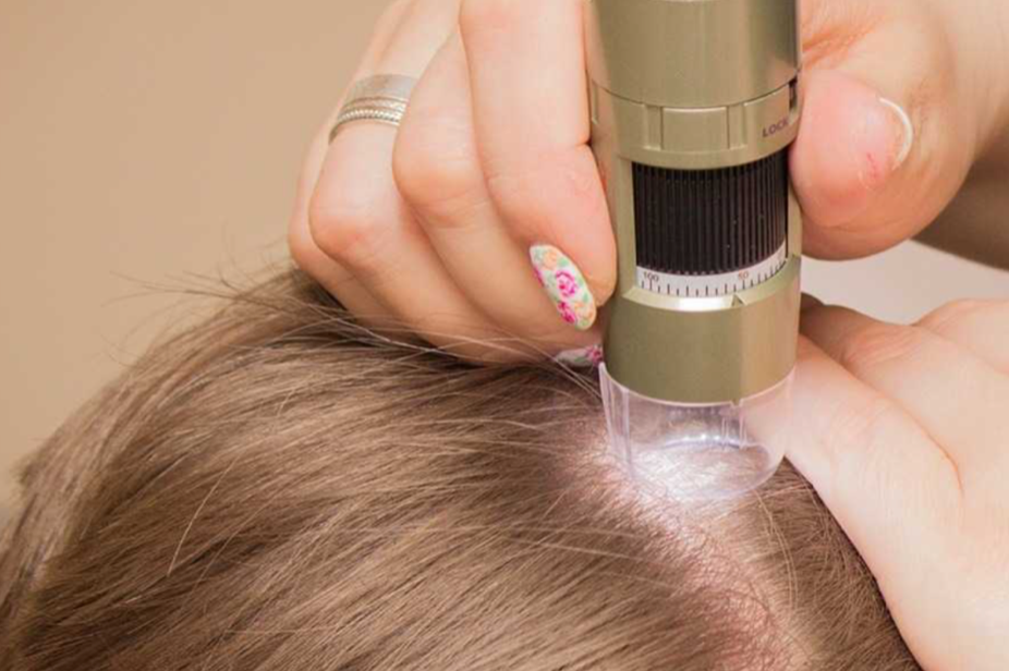 hair microneedling