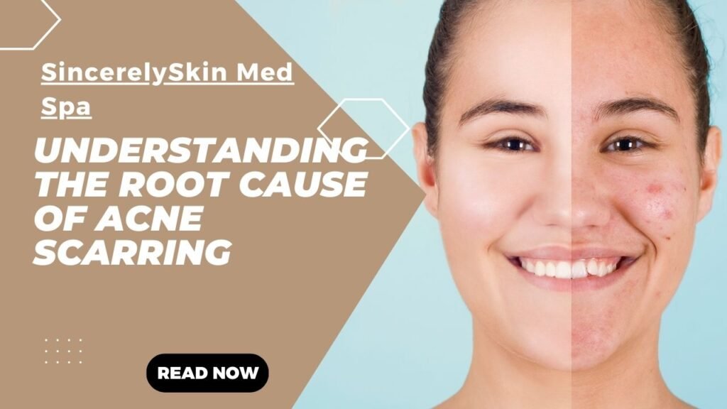 Understanding the Root Cause of Acne Scarring