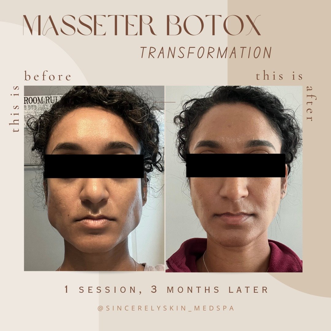 Masseter Botox