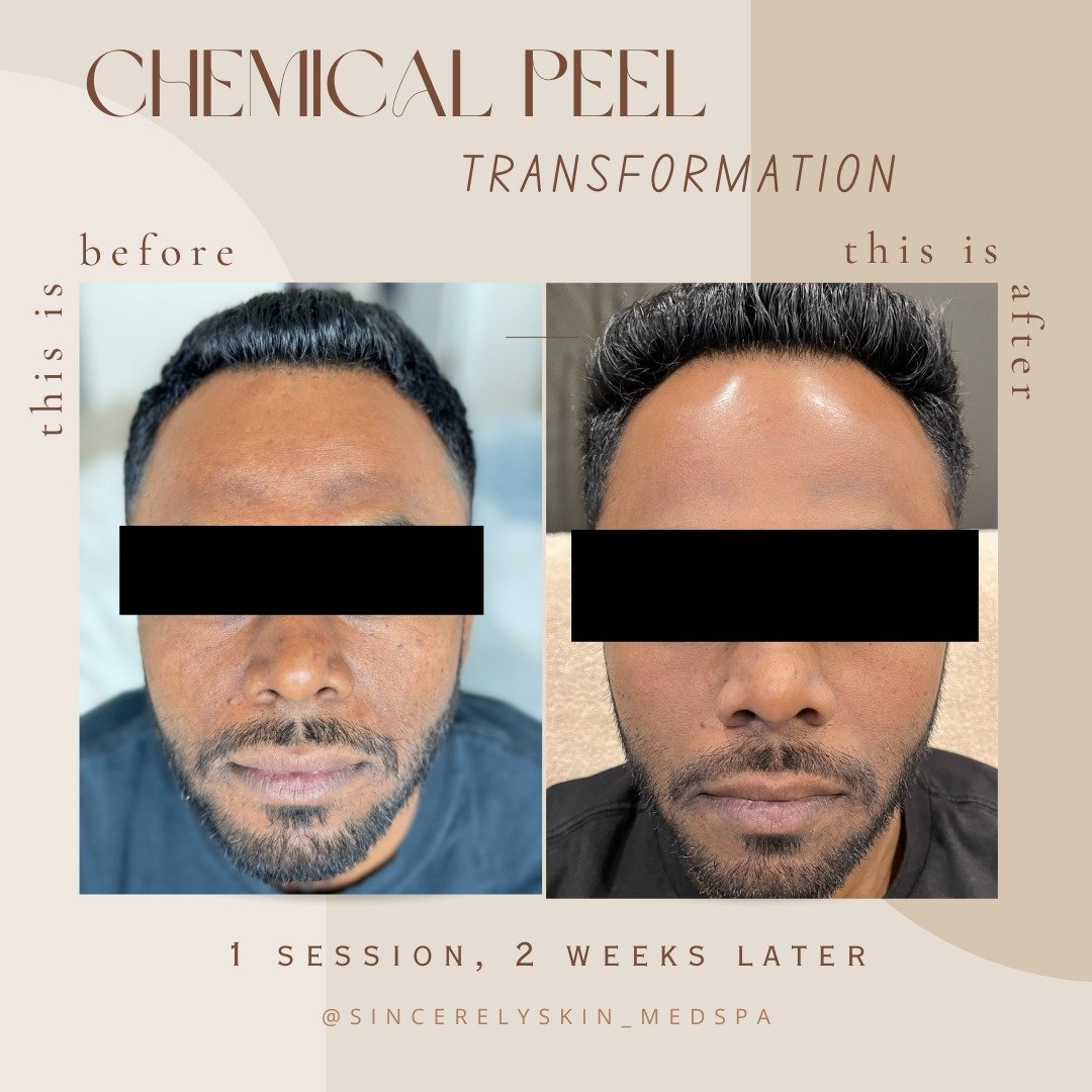 Chemical Peel