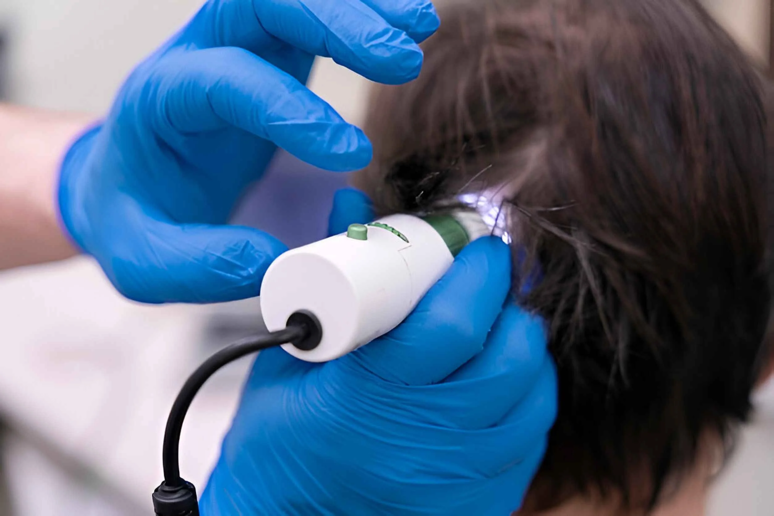 Man getting a hair loss treatment microneedling hair with exosomes (1)