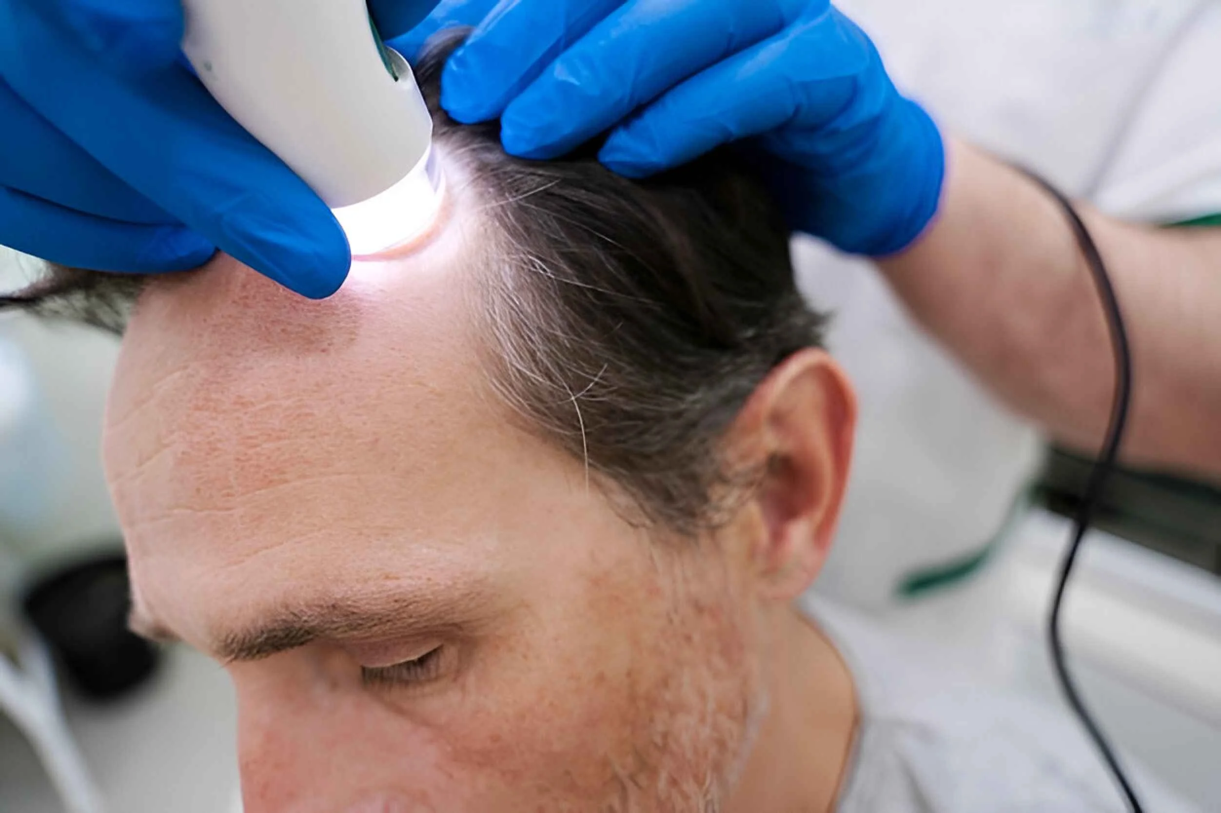 Man getting a hair loss treatment with growth factors (1)