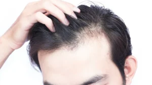 Grow Your Hair Without a Hair Transplant