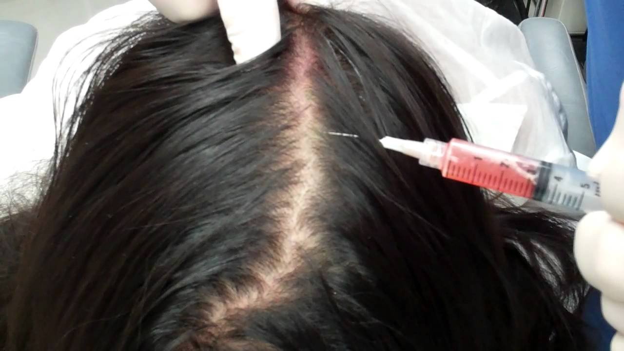 RP Injections for Hair Loss in Edgewater, New Jersey