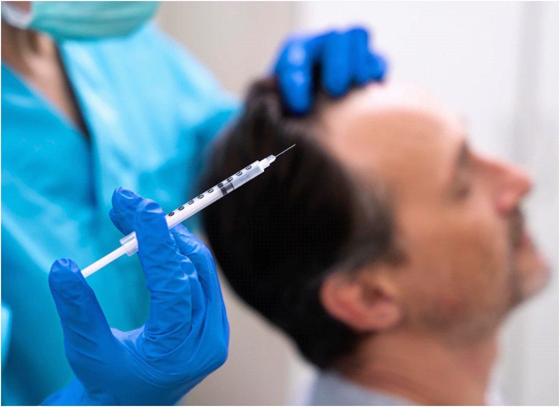 RP Injections for Hair Loss in Edgewater, New Jersey