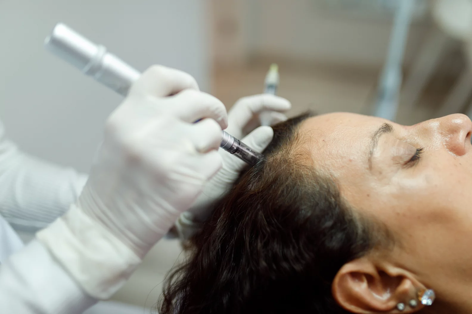 Microneedling for Hair Loss in Edgewater, New Jersey