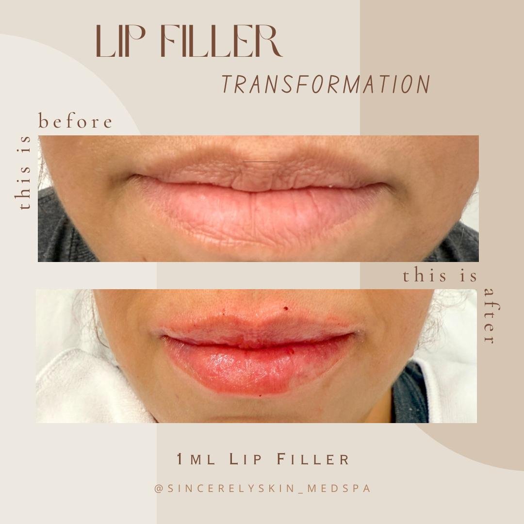 Lip fillers before after