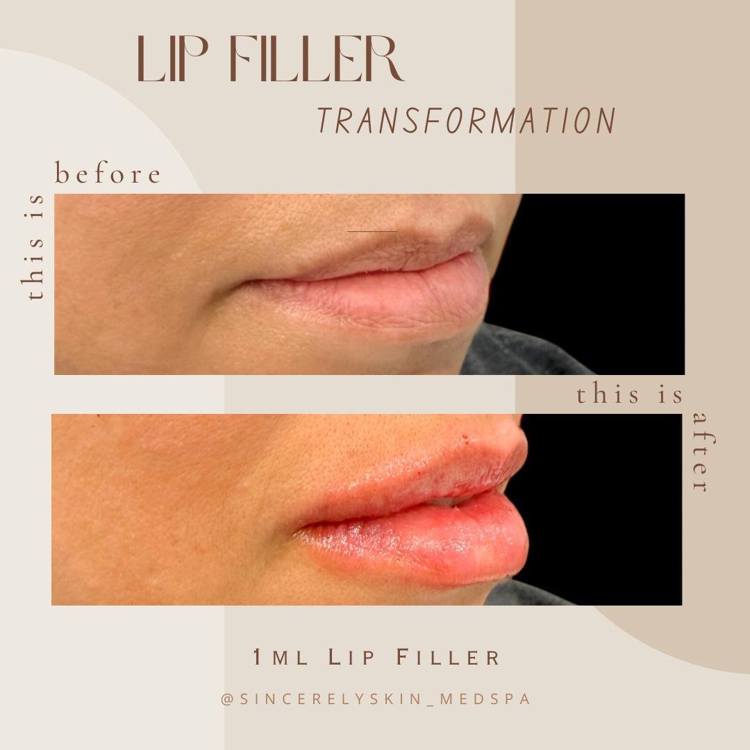 Lip fillers before after