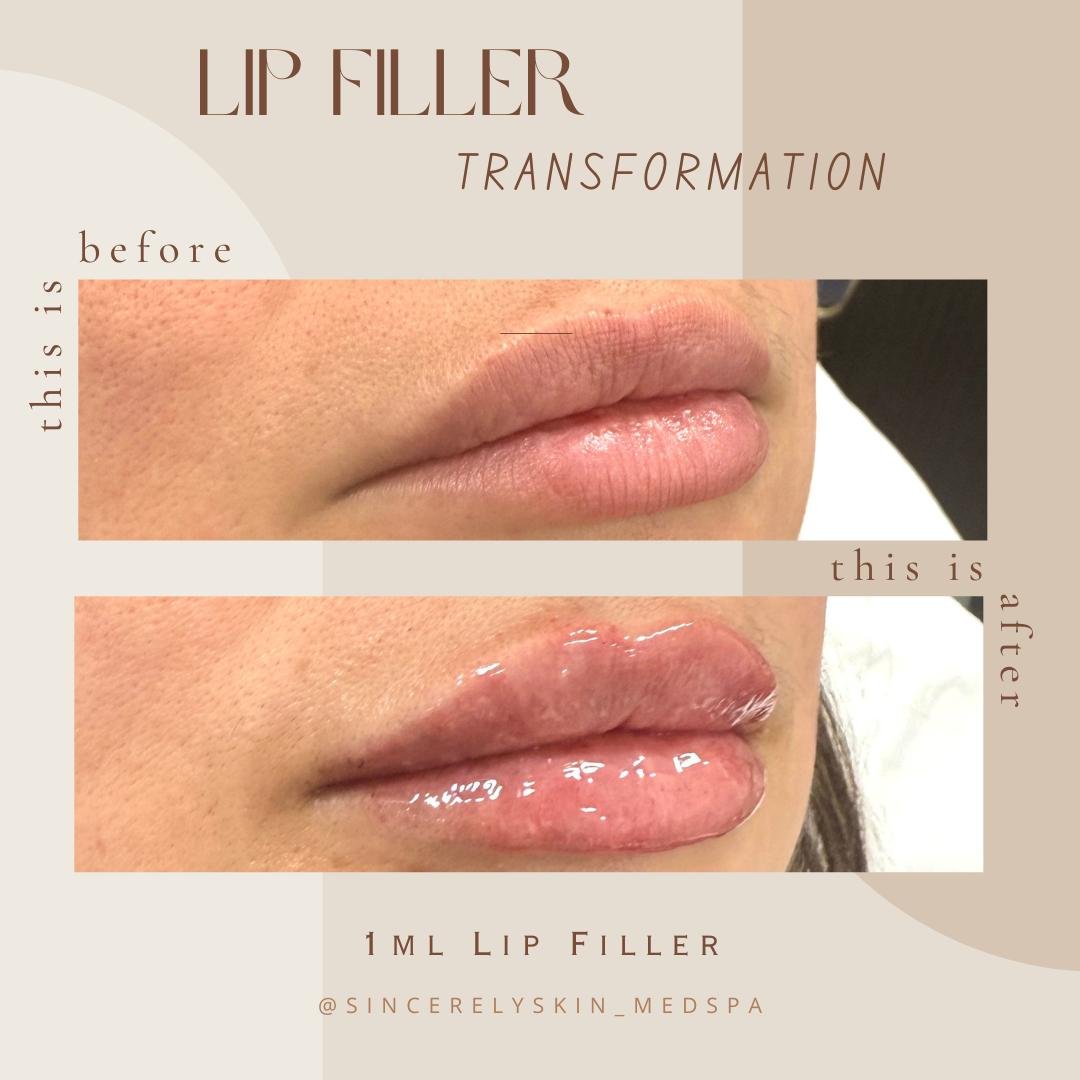 Lip fillers before after