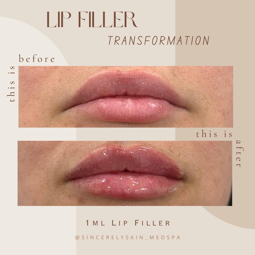 Lip fillers before after