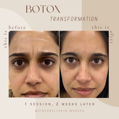 Before-After -1