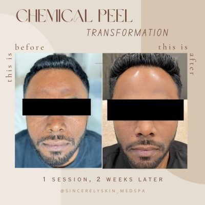 Before-After -2