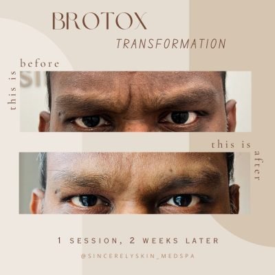 Before-After -6